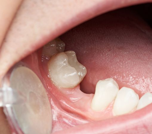 Perché bisogna sostituire i denti mancanti?