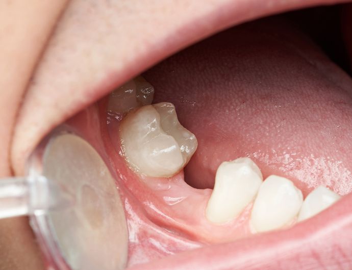 Perché bisogna sostituire i denti mancanti?