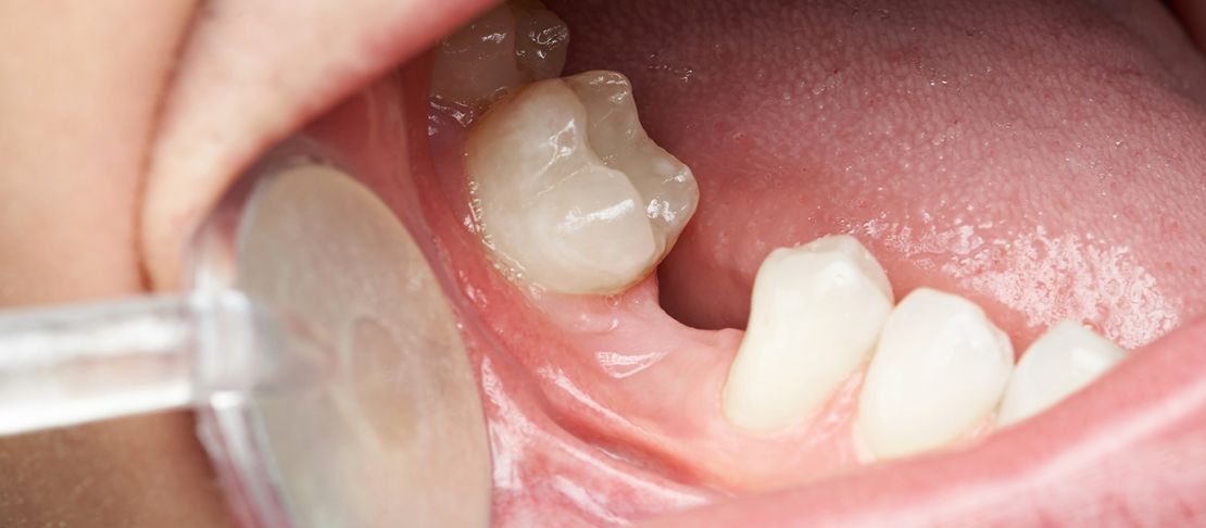 Perché bisogna sostituire i denti mancanti?