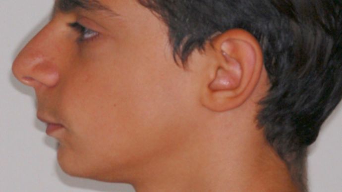 Caso ortopedico / ortodontico