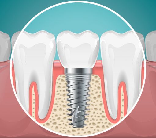 In quali casi inserire gli impianti dentali?