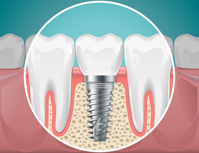 In quali casi inserire gli impianti dentali?