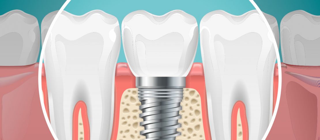 In quali casi inserire gli impianti dentali?